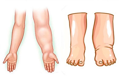 Resultado de imagen para linfedema